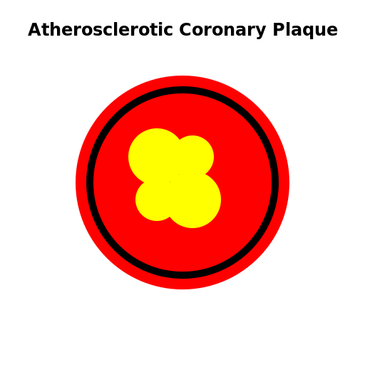 Atherosclerotic Coronary Plaque - DrawGPT
