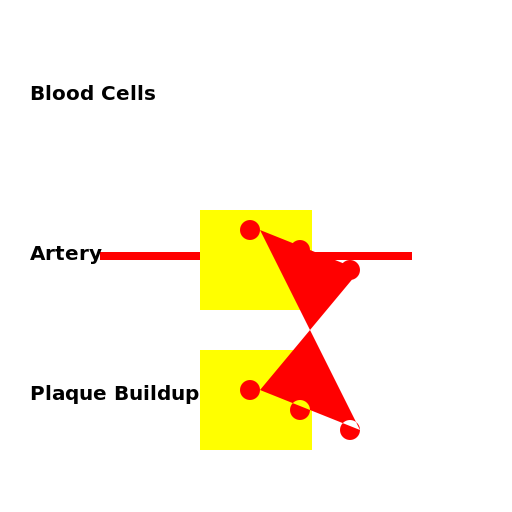 Coronary Atherosclerosis - DrawGPT