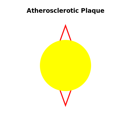 atherosclerotic plaque burden - DrawGPT