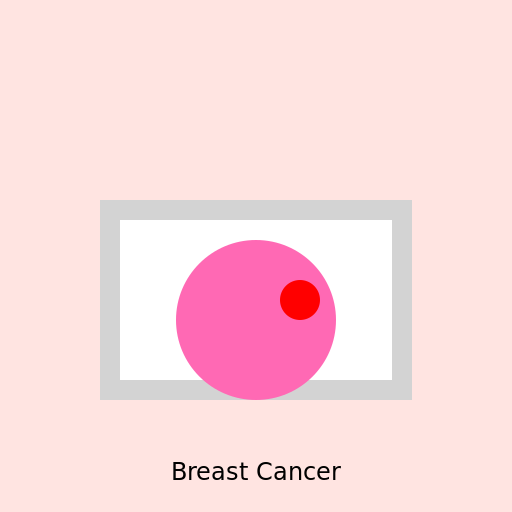 Breast Cancer in a Mammography - DrawGPT