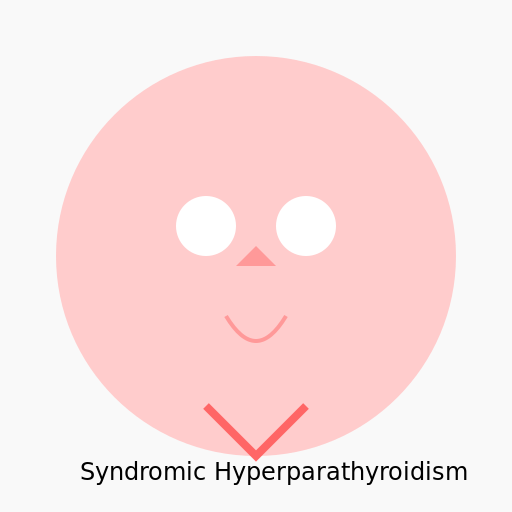 Syndromic Hyperparathyroidism - DrawGPT