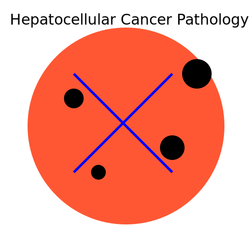 Hepatocellular Cancer Pathology - AI Prompt #39762 - DrawGPT