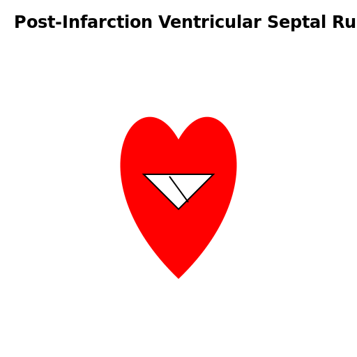 Post-Infarction Ventricular Septal Rupture - AI Prompt #40459 - DrawGPT