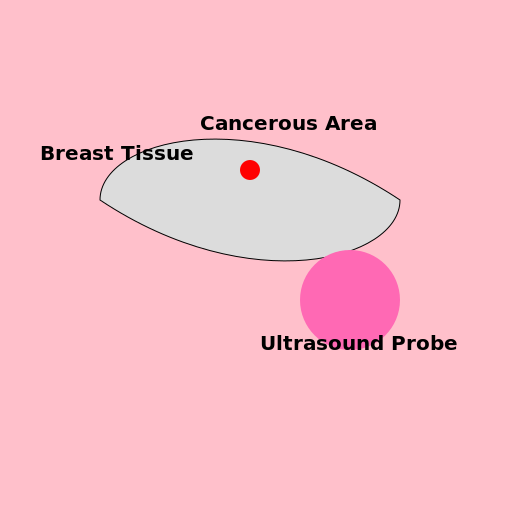 Ultrasound Diagnosis of Breast Cancer - AI Prompt #53671 - DrawGPT