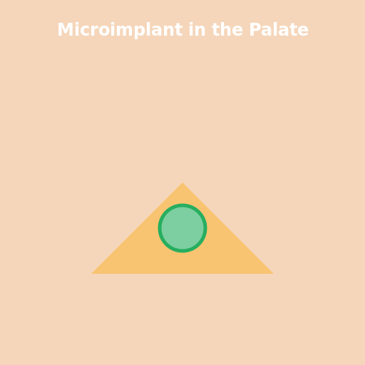 A Microimplant in the Palate - DrawGPT