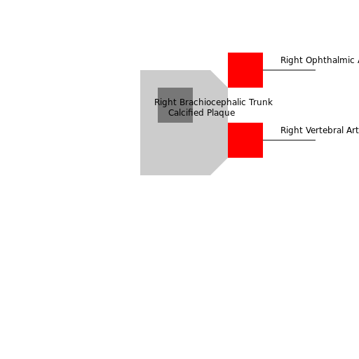 Calcified Blockage - DrawGPT
