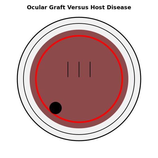 Eye with Ocular Graft Versus Host Disease - DrawGPT