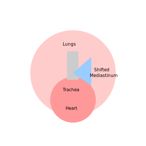 Mediastinal Shift - DrawGPT