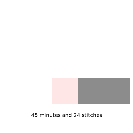Mike Mastro's 8-Inch Stick Removal Surgery - DrawGPT